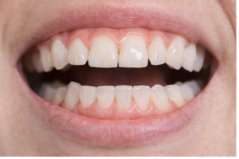 Apiñamiento dental: caso clínico antes del tratamiento
