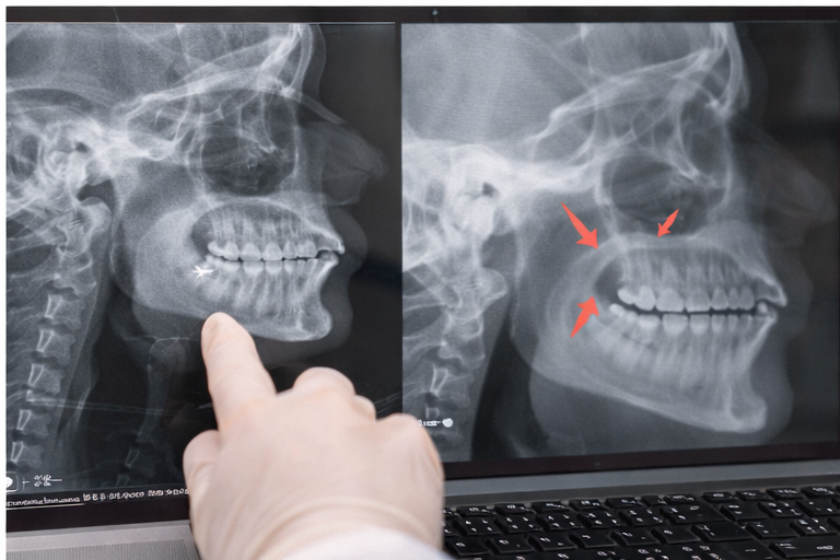 Radiografía dental utilizada para planificar el tratamiento del apiñamiento dental Radiografía para planificar extracciones en ortodoncia