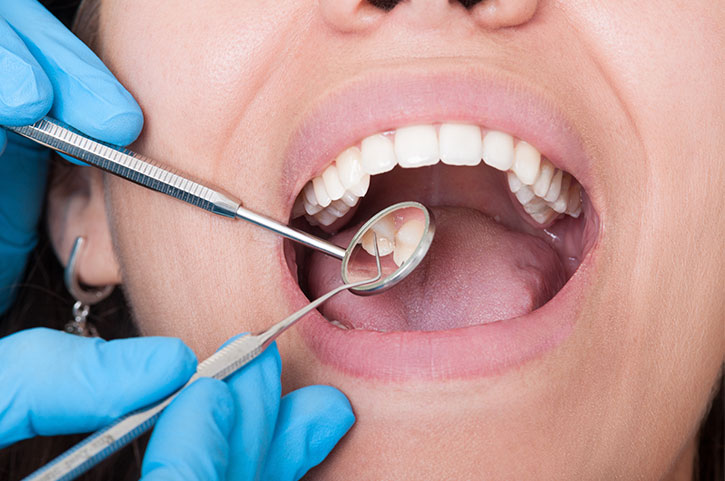 Caries dentales: todo lo que debes saber