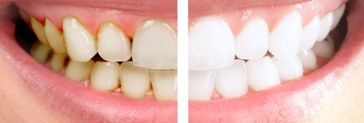 Tinciones dentales: por qué se originan y cómo tratarlas