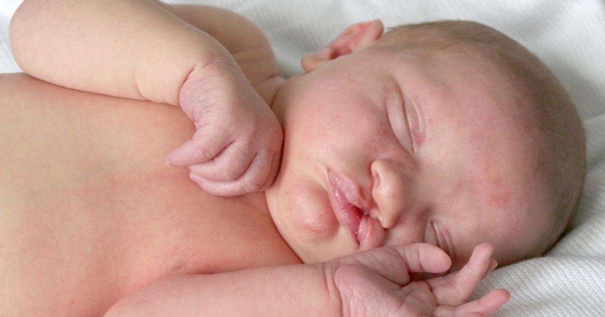 Paladar hendido: qué es, causas y tratamiento