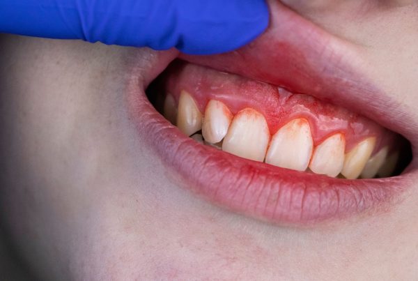 Encías sangrantes: por qué ocurre y cómo se puede tratar | Clinica Dental Ramis Gandía encías sangrantes