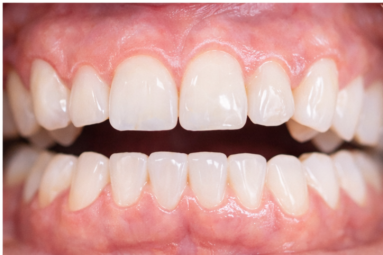 Alineadores transparentes tras el stripping dental
