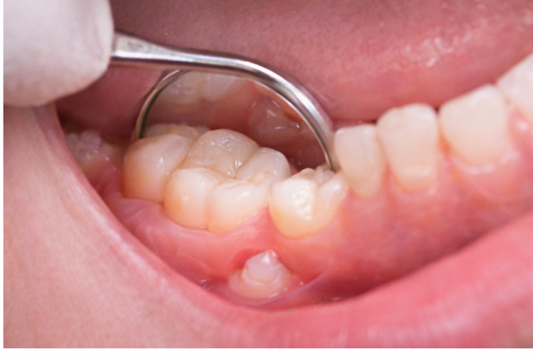 Erupción de molares en niños