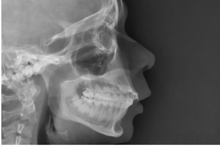 Radiografía lateral para el diagnóstico de retrognatia mandibular