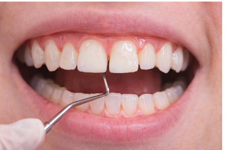 Erupción de caninos permanentes