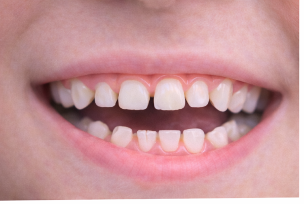 Dientes pequeños o microdoncia en incisivos