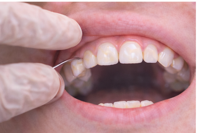 Diagnóstico clínico de MIH en odontopediatría