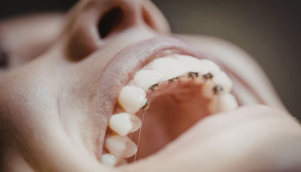 Home | Clinica Dental Ramis Gandía recidiva ortodoncia
